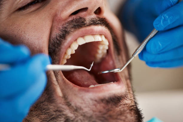 Best Emergency Wisdom Teeth Removal in Culver City, CA